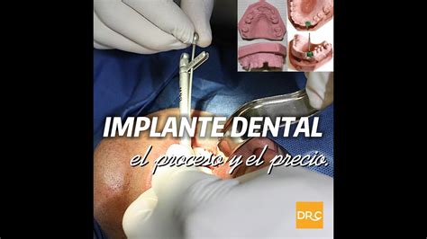 Implante Dental. Procedimiento y precio!! - YouTube