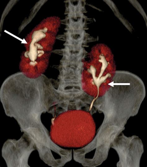 Congenital Anomalies Of The Upper Urinary Tract A Comprehensive Review ...