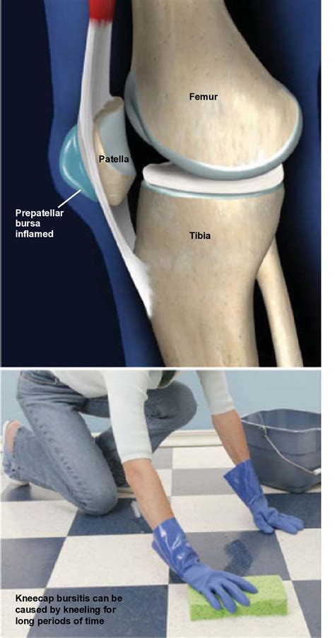 Prepatellar Bursitis (Kneecap Bursitis) - Dr. Mark Tuttle