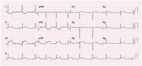 Acute coronary syndrome, Myocardial Infarction, Unstable Angina - Cancer Therapy Advisor