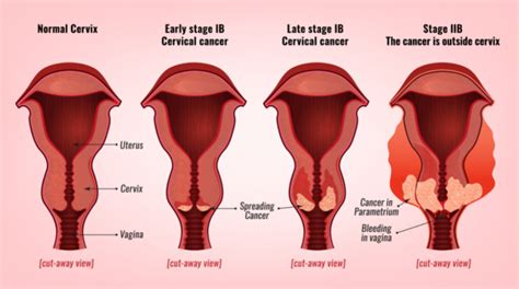 Cervical Cancer Stages | Prof Andreas Obermair » Professor Andreas Obermair