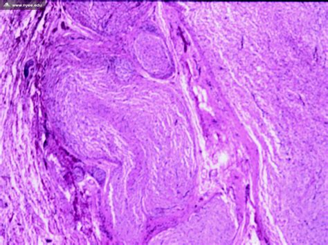 Histology: Plexiform Neurofibroma - NYEE