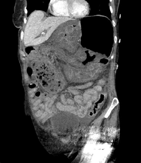 CT scan from four years prior to presentation showing evidence of ...