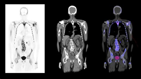 Pet Ct Scan For Prostate Cancer at teresasbrocko blog