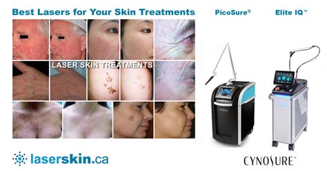 SALE on Port Wine Stain Laser Treatment | LASERSKIN.CA