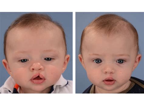 Cleft Lip Before and After Photos — Dallas Pediatric Plastic Surgeon ...