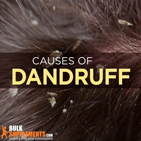 What Causes Dandruff In Hair