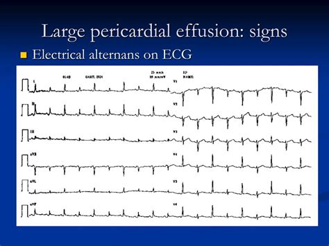 PPT - Pericardial Disease PowerPoint Presentation, free download - ID:4744290