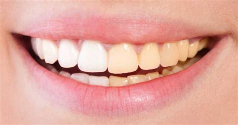 Teeth whitening oakville - Should you seek out a dentist for white teeth?