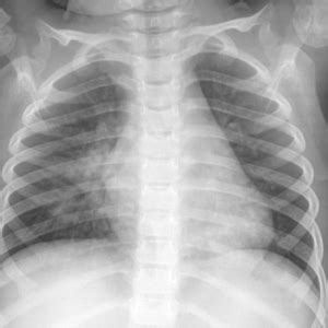 Chest X-ray of a 3-year-old female patient with signs of pneumonia showing a right perihilar ...