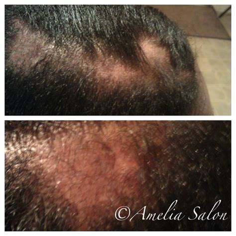 Lupus and Hair Loss - Amelia Salon