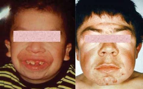 Angelman syndrome: MedlinePlus Genetics