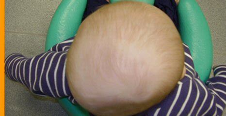 PLAGIOCEPHALY AND CRANIAL OSTEOPATHY. | DUBLIN OSTEOPATH