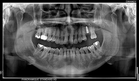 I-Max 3D PRO - Cone beam - CBCT - Owandy Radiology