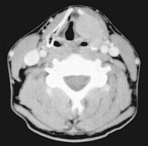 CT-scan of the neck and larynx. | Download Scientific Diagram