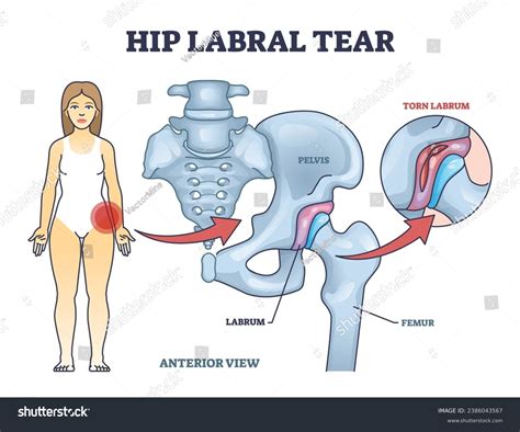 Hip Labral Tear Anatomical Explanation Medical Stock Vector (Royalty Free) 2386043567 | Shutterstock