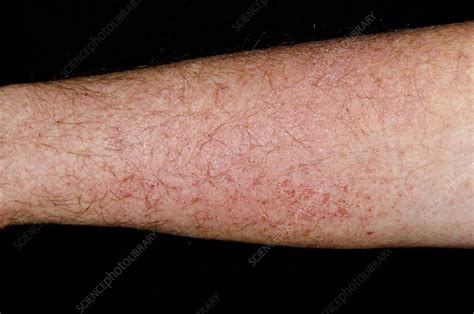 Photosensitive rash on the arm - Stock Image - C013/0857 - Science ...