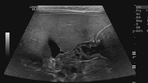 Pyloric Ultrasound – Sonographic Tendencies