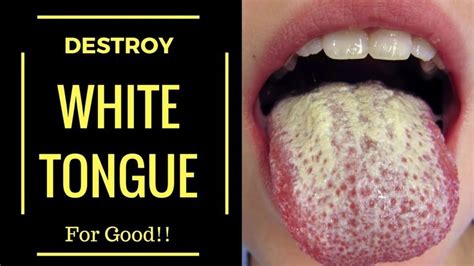 What Causes White Tongue and Are There Any Treatments For White Tongue ...