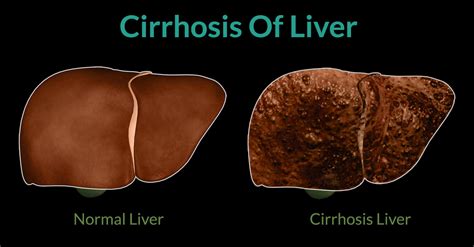 Cirrhosis Of Liver Treatment In Iran | Medpersia Medical Tourism