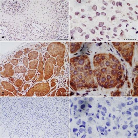 Nuclear localization of BRAF V600E in melanoma cells. SkMel-28 and ...