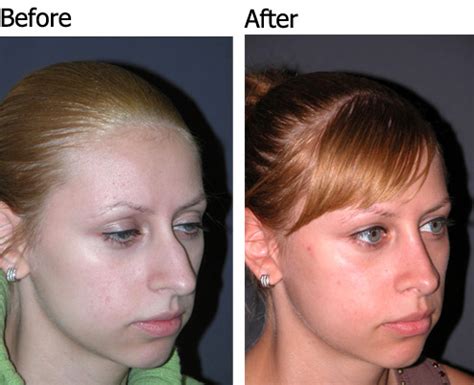 Best Rhinoplasty Surgeon | Best Rhinoplasty Surgeon in America