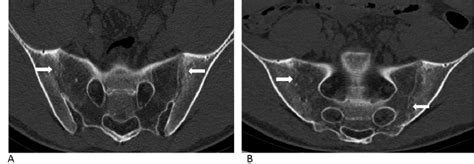 Sacroiliitis – Findings on Conventional Radiography, CT and MRI studies | Semantic Scholar