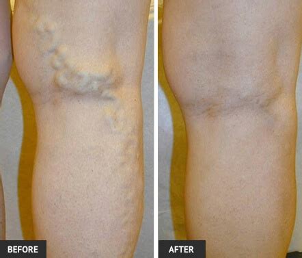 Varicose Veins During Pregnancy Treatment | St Louis