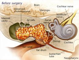 MASTOIDECTOMY FOR CHOLESTEATOMA OR INFECTION, Geelong, Ballarat