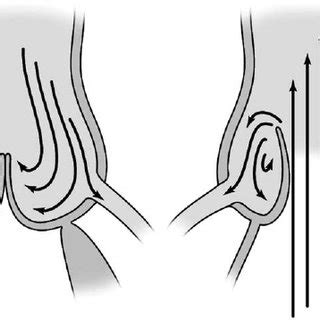 The aortic sinuses form an integral part of the normal aortic valve ...