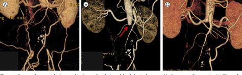 Figure 1 from Complete Revascularization of Juxtarenal Aortic Occlusion by Endovascular ...