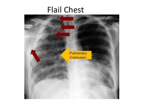 Flail Chest, Thoracic, Pulmonary, Radiology, Trauma, Movie Posters ...