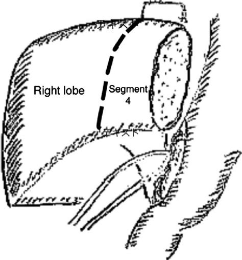 The hepatoduodenal ligament is encircled with the stomach tube pulled... | Download Scientific ...