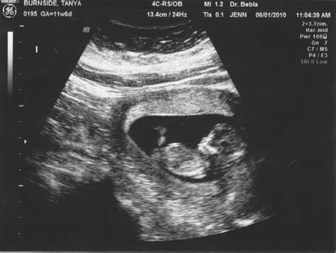 Scott & Tanya's Pregnancy blog: 12 Week Sonogram