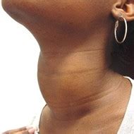 Goiter: Definition, Symptoms Of Goiters, Causes, Diagnostic Procedures, Treatment With ...