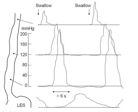 Esophageal motility study - Alchetron, the free social encyclopedia