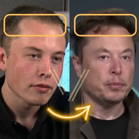 Elon Musk's Hair Transplant: Before and After Transformation