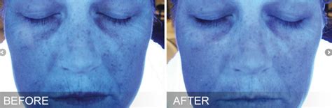 Hydrafacial Before and After Photos - London Premier Laser & Skin Clinic