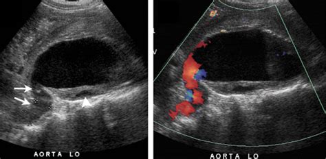 Ultrasound in Abdominal Aortic Aneurysm | IntechOpen