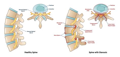 Spinal Stenosis: Definition, Causes, Symptoms, Diagnosis, and Treatment ...