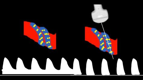 Umbilical Artery Doppler interpretation - YouTube