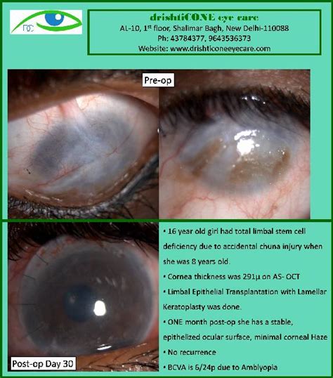 Limbal Stem Cell Deficiency does not benefit ONLY with a Corneal Transplantation