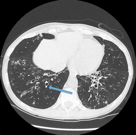 Radiology - Bronchiectasis