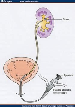 Holmium Laser Stone Surgery using Flexible Pyelo- Ureteroscopy Penrith ...