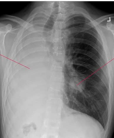 DASAR MEMBACA FOTO THORAX / CHEST X RAY – radiologi.id