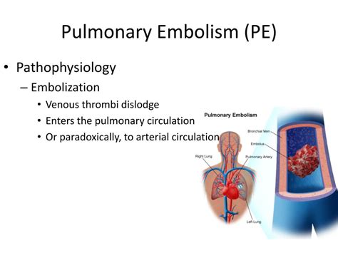 Pulmonary Embolism