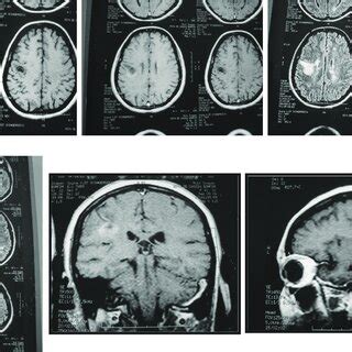 (September 2006) MRI images of the large tumefactive MS lesion, showing ...