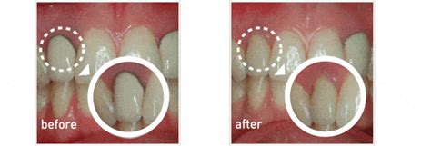 Zirconia Dental Implants-What are they and the Benefits