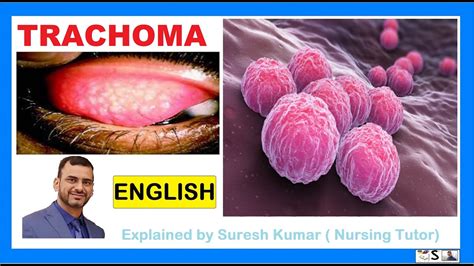 TRACHOMA / CAUSES, TREATMENT AND PREVENTIVE MEASURES OF TRACHOMA / EYE INFECTION - YouTube