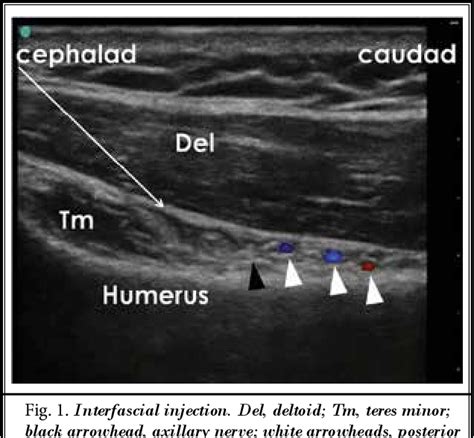 Ultrasound-Guided Block of the Axillary Nerve: A Prospective, Randomized, Single-Blind Study ...